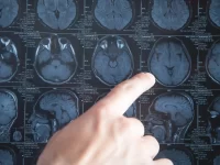 Hallan niveles preocupantes de micronanoplásticos en arterias de pacientes con ictus