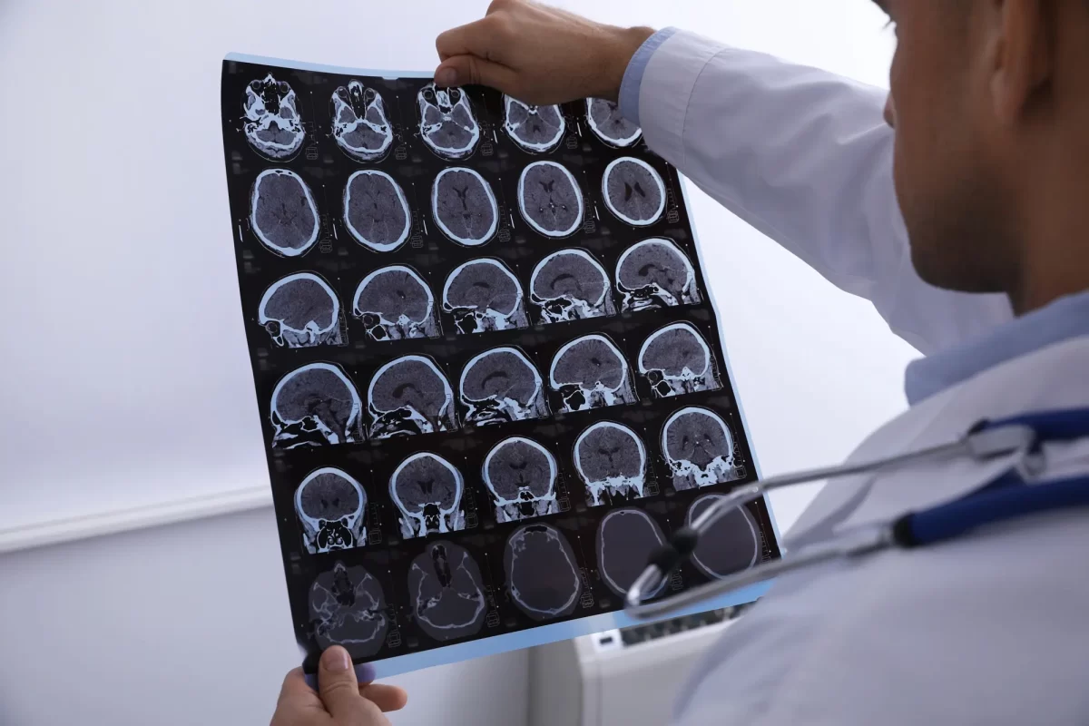 La arquitectura oculta del cerebro hiperactivo revela dos subtipos físicos distintos