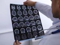 La arquitectura oculta del cerebro hiperactivo revela dos subtipos físicos distintos