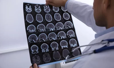 La arquitectura oculta del cerebro hiperactivo revela dos subtipos físicos distintos